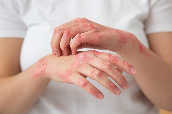 Treatment For Syphilis In Brahmapur