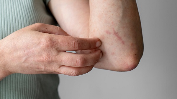 Treatment For Genital Herpes & Warts In Turin